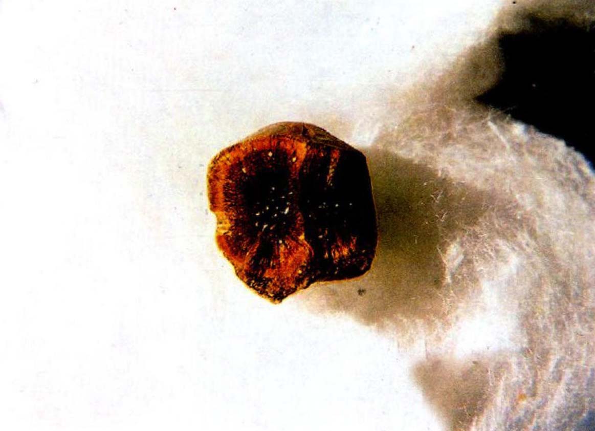 膽囊結(jié)石的剖面形態(tài)及分類